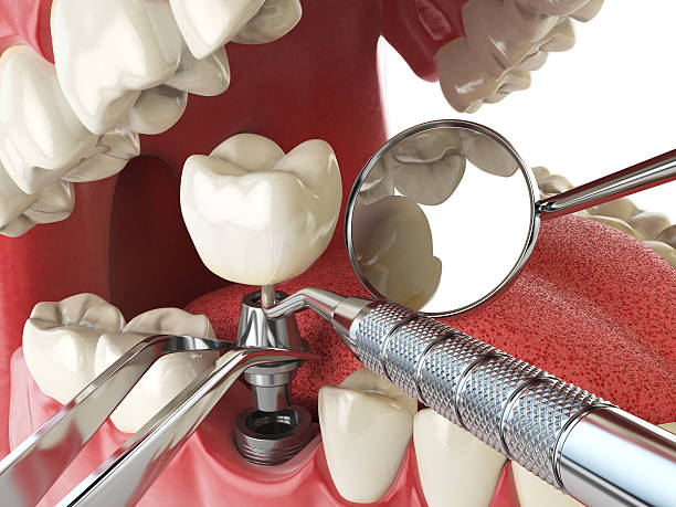 Best Lost Filling or Crown Replacement in Wingate, NC